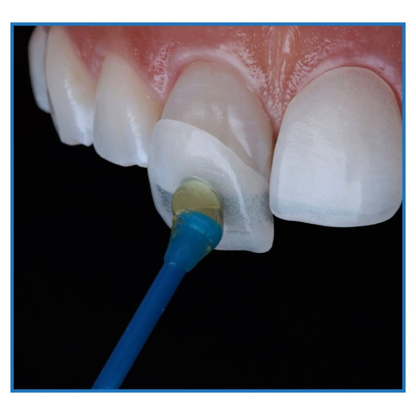 Smart Dental Veneer Stick (Set Of 20 Pcs)