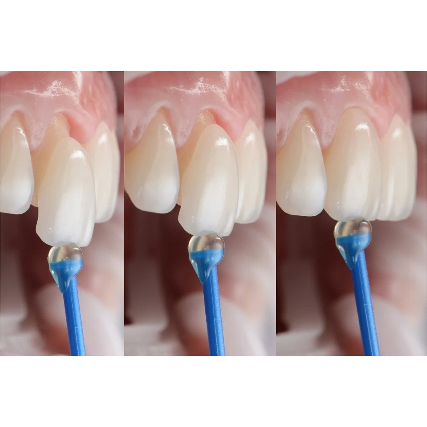 Smart Dental Veneer Stick (Set Of 20 Pcs)