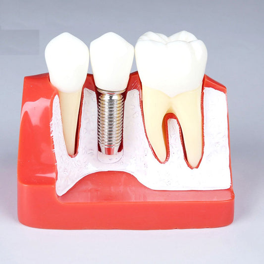 Implant Analysis Model