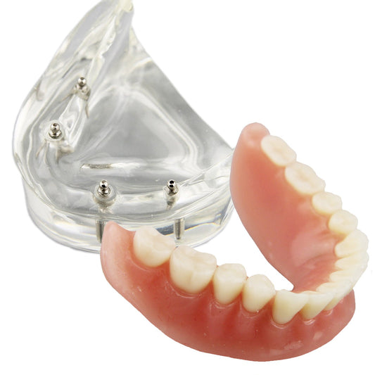 Over Denture Model