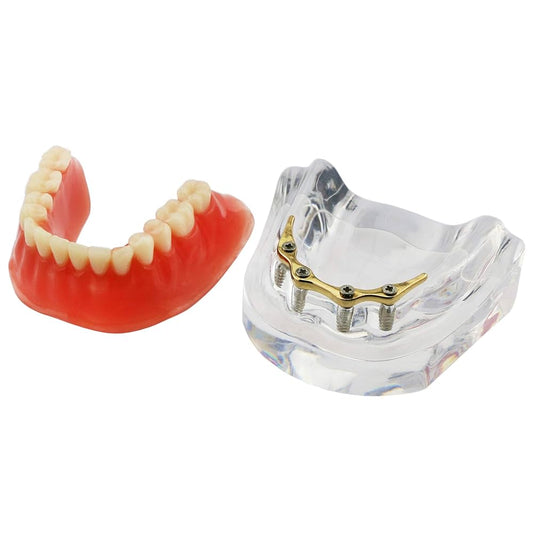 Implant Model With Bar