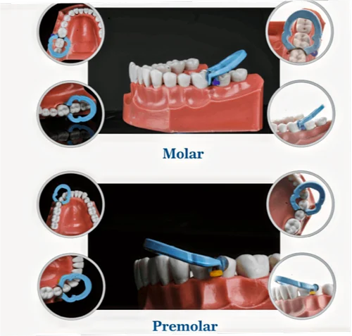 Younitrix Dental Ring