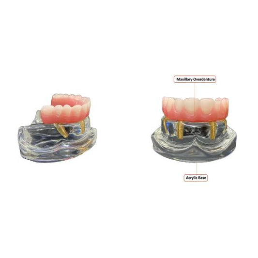 All On Four Implant Model