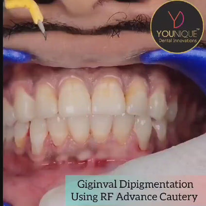 Radio Frequency Advance Cautery