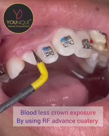 Radio Frequency Advance Cautery