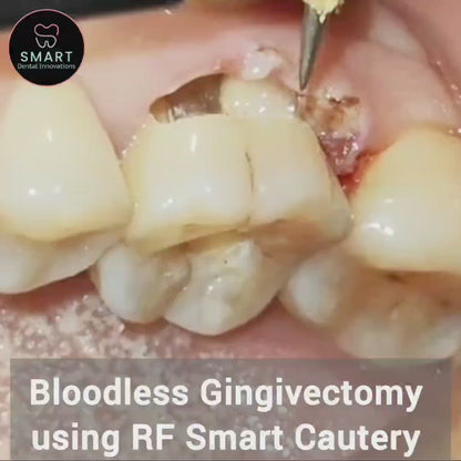 Radio Frequency Smart Cautery
