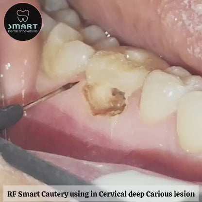 Radio Frequency Smart Cautery